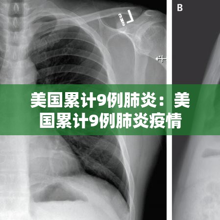 美国累计9例肺炎:美国累计9例肺炎疫情 美国累计9例肺炎:美国累计9例肺炎疫情